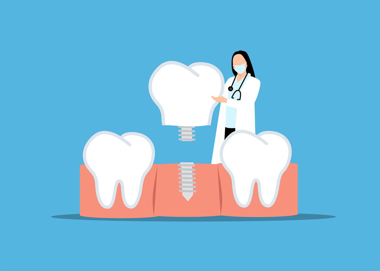 imagen caricaturesca de implantes dentales